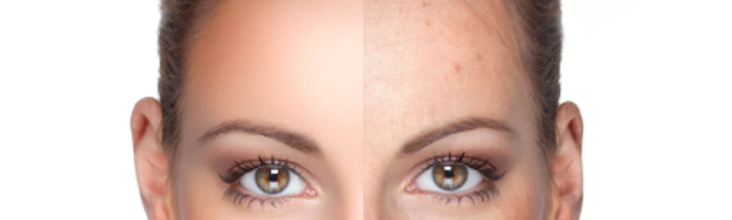 Skin Pigmentation